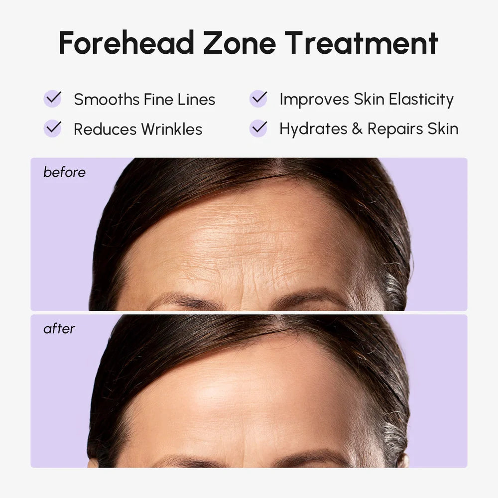 Before and after treatment of forehead zone with text highlighting benefits on a purple background